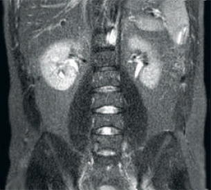 Recepci&oacute;n de radiofrecuencia