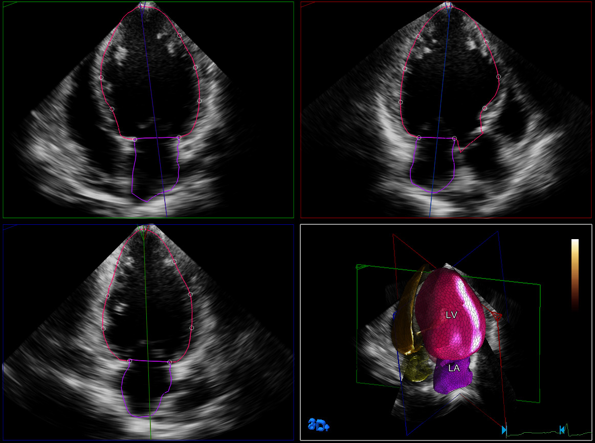 cuantificaci&oacute;n ecocardiogr&aacute;fica transtor&aacute;cica 3D
