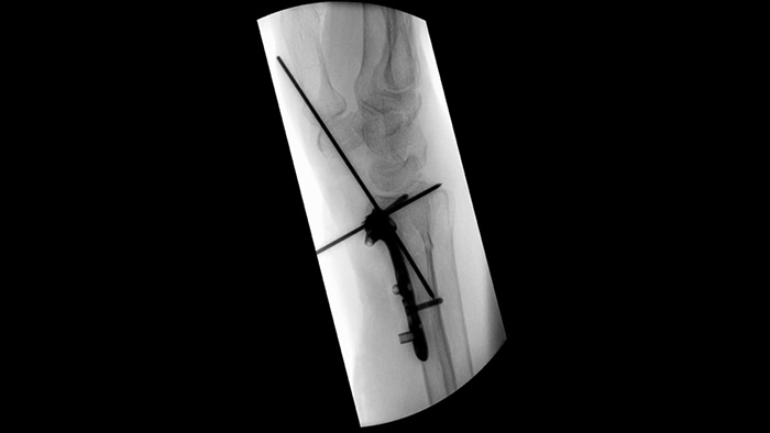 Colimaci&oacute;n asim&eacute;trica