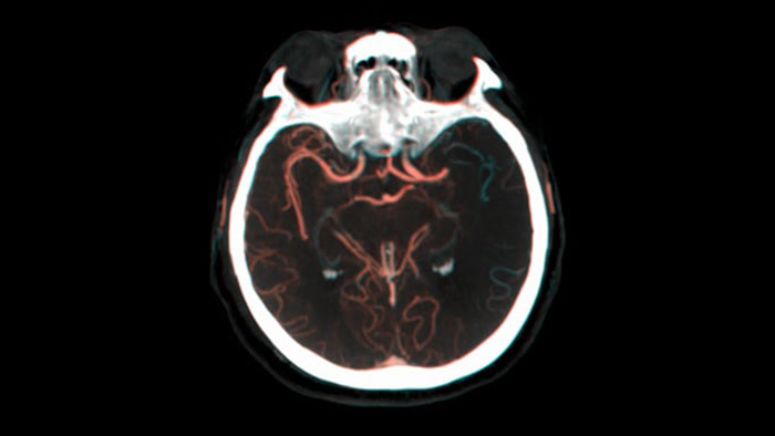 Visualizaci&oacute;n del llenado colateral