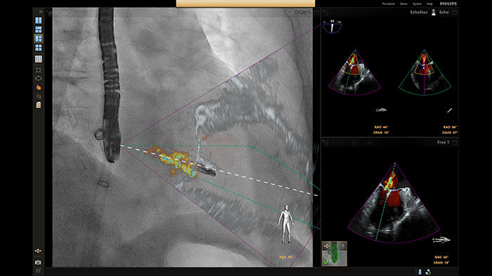 Fusi&oacute;n de MClip Xplane