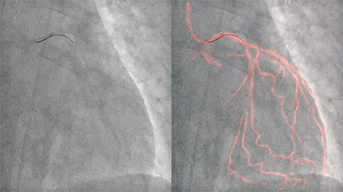 Herramientas exclusivas de orientaci&oacute;n coronaria