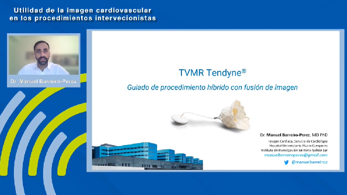 Procedimiento de implante de v&aacute;lvula mitral Tendyne transapical hibrido (Transcateter + Cirug&iacute;a Cardiaca) con fusi&oacute;n de imagen - Dr. Manuel Barreiro P&eacute;rez