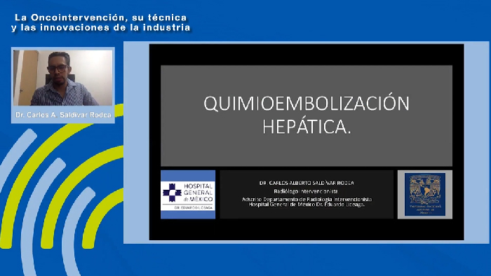 Quimioembolizaci&oacute;n hep&aacute;tica (TACE) &ndash; Dr. Carlos Alberto Saldivar Rodea