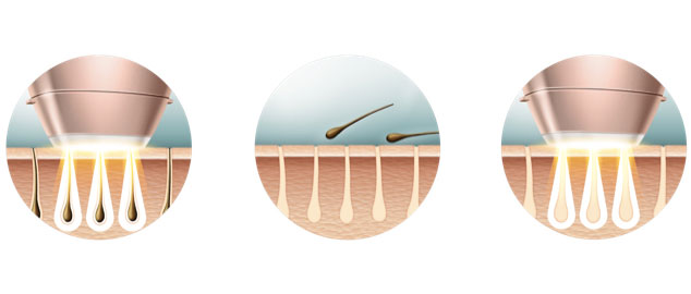 La tecnolog&iacute;a detr&aacute;s de la luz pulsada 