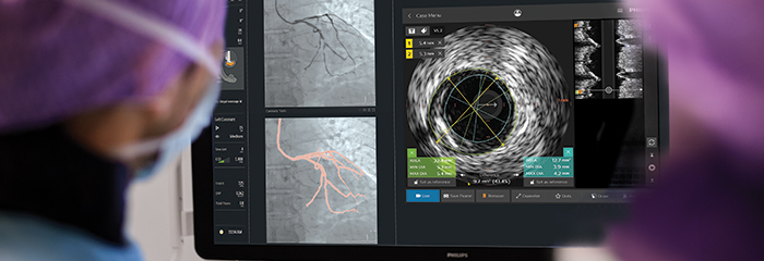 Ventana emergente del tratamiento de coronariopat&iacute;as con IntraSight