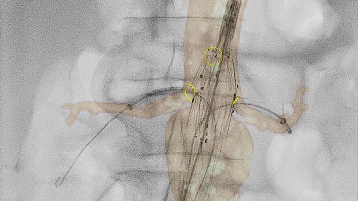 Vista en miniatura de la perfusión vascular 2D