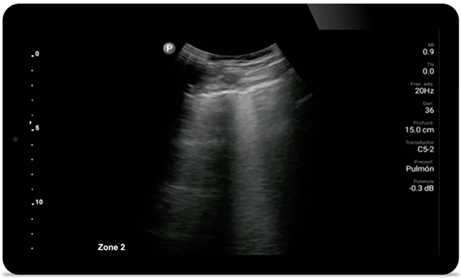 Est&eacute; atento a la neumon&iacute;a por COVID
