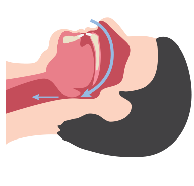 V&iacute;as respiratorias obstruidas