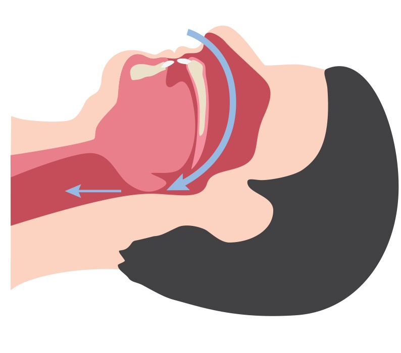 V&iacute;a respiratoria obstruida